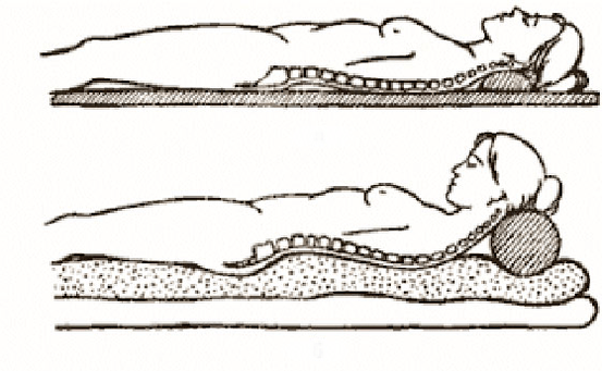 Postava osteochondrózy